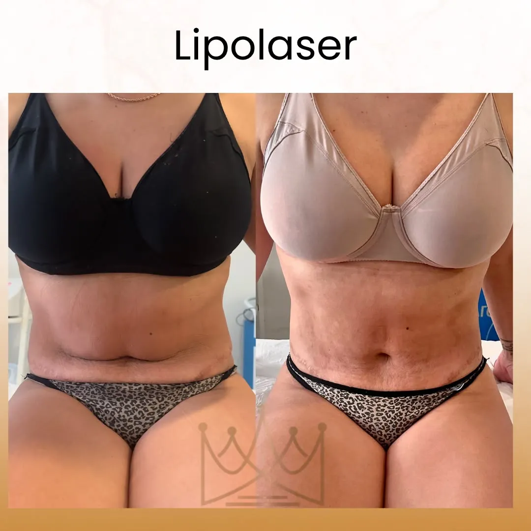 LipoLaser